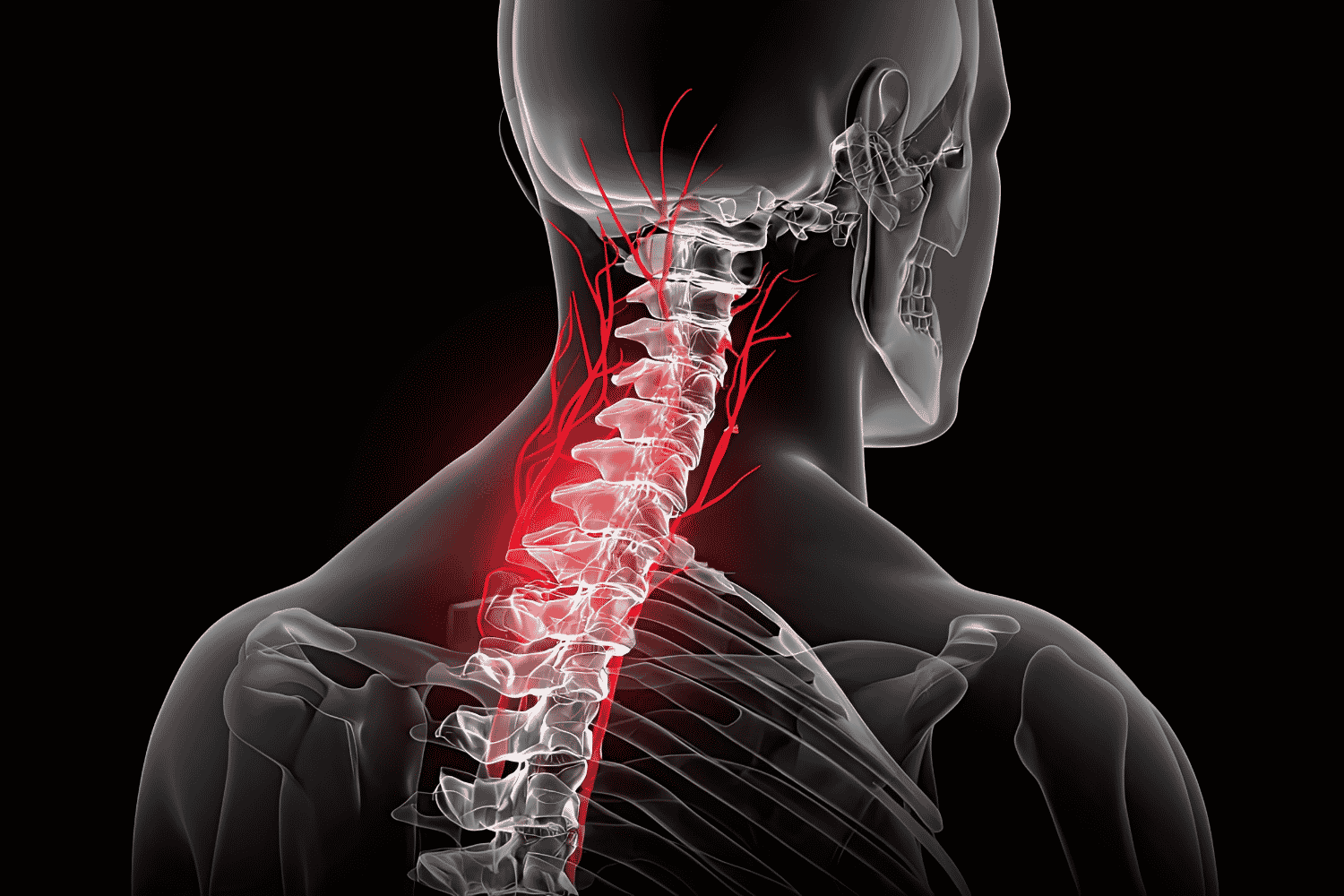 spondylosis